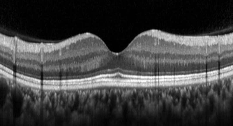 [그림] 망막 두께를 정밀 분석하는 빛간섭단층촬영 영상.jpg