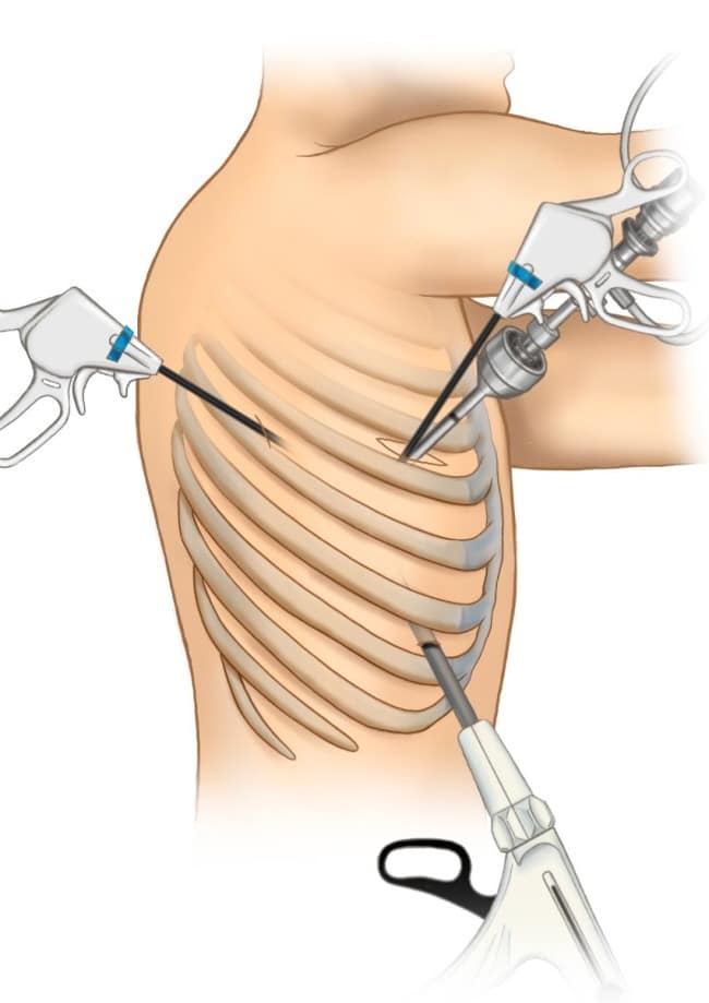 [그림1] 표준적인 흉강경 폐절제 수술, 갈비뼈 사이로 절개창을 내 신경 손상 후유증의 위험이 높다 .jpg